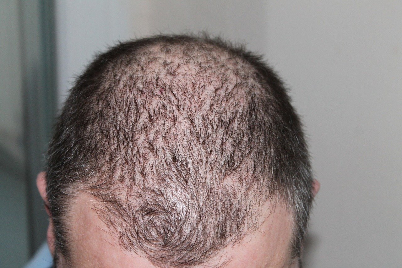 understand male pattern baldness